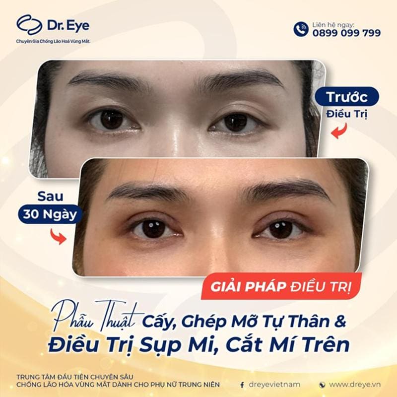 Cấy mỡ tự thân để chữa hốc mắt sâu