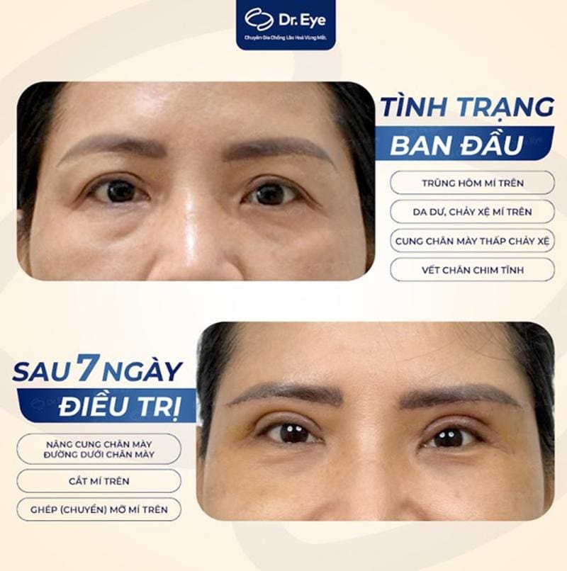 Khách hàng chữ hốc mắt sâu tại Dr. Eye