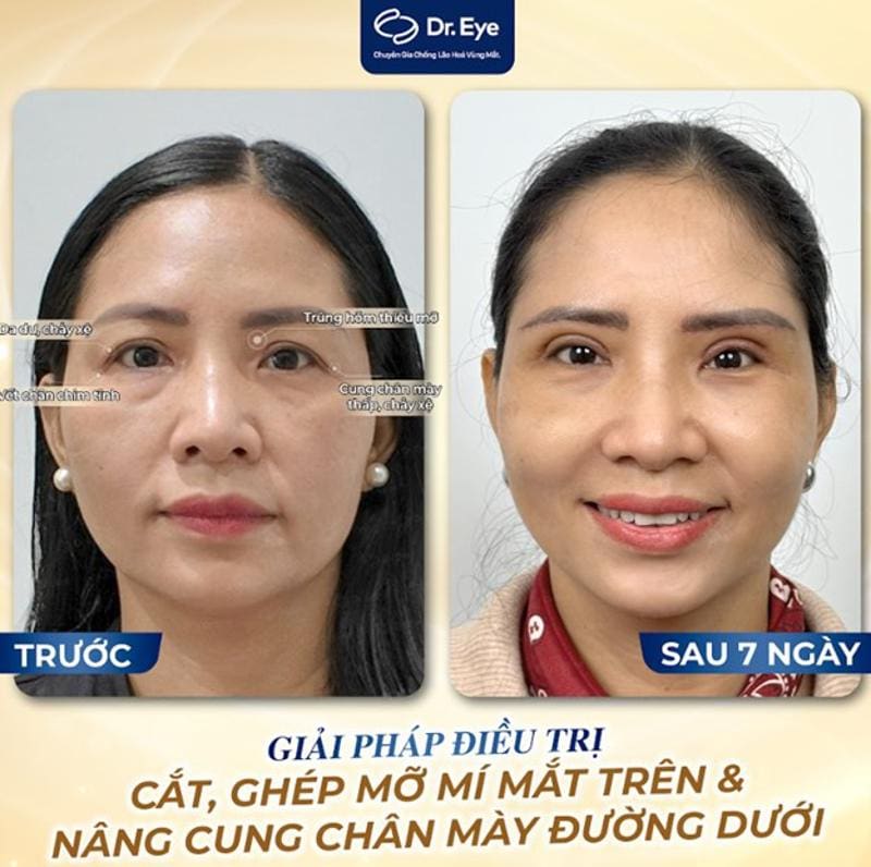 Khách hàng chữ hốc mắt sâu tại Dr. Eye