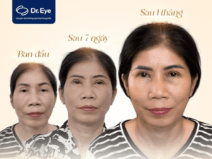 Chỉnh sửa mí bị lỗi sau cắt mí cùng Dr. Eye: Tìm lại tự tin và niềm vui tuổi trung niên