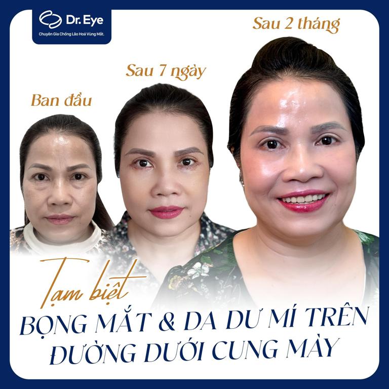 cách làm hết bọng mắt dưới