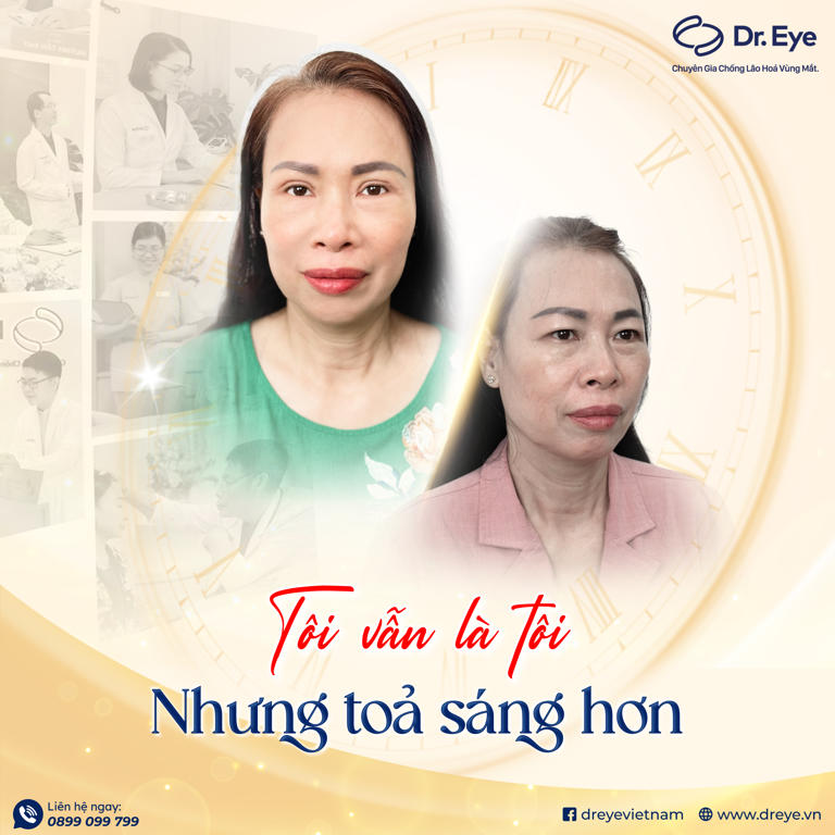 điều trị cắt mí mắt tại Dr eye