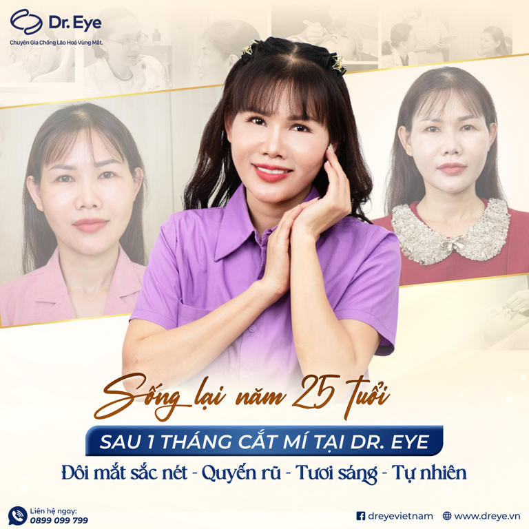 Lấy lại vẻ đẹp sau khi cắt mí tại dr eye