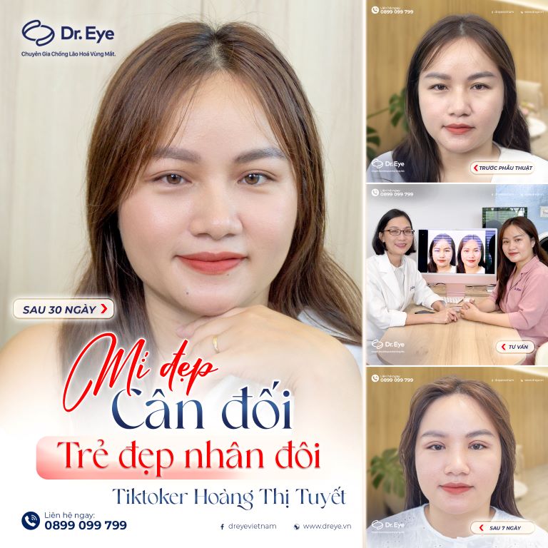 lấy mỡ mí mắt