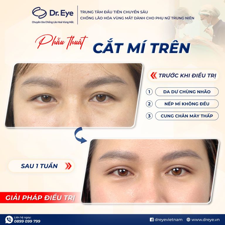 chăm sóc mắt sau cắt mí