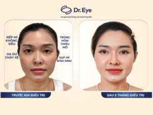 Đẹp hơn, năng lượng hơn sau thay đổi nhỏ ở đôi mắt 