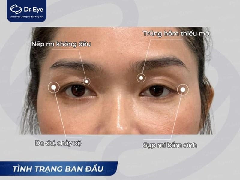 Dấu hiệu cần cấy mỡ hốc mắt