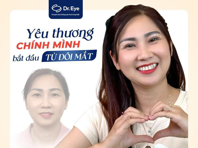 Hành Trình Tìm Lại Đôi Mắt Tự Tin Sau Sinh Của Chị Gái 38 Tuổi