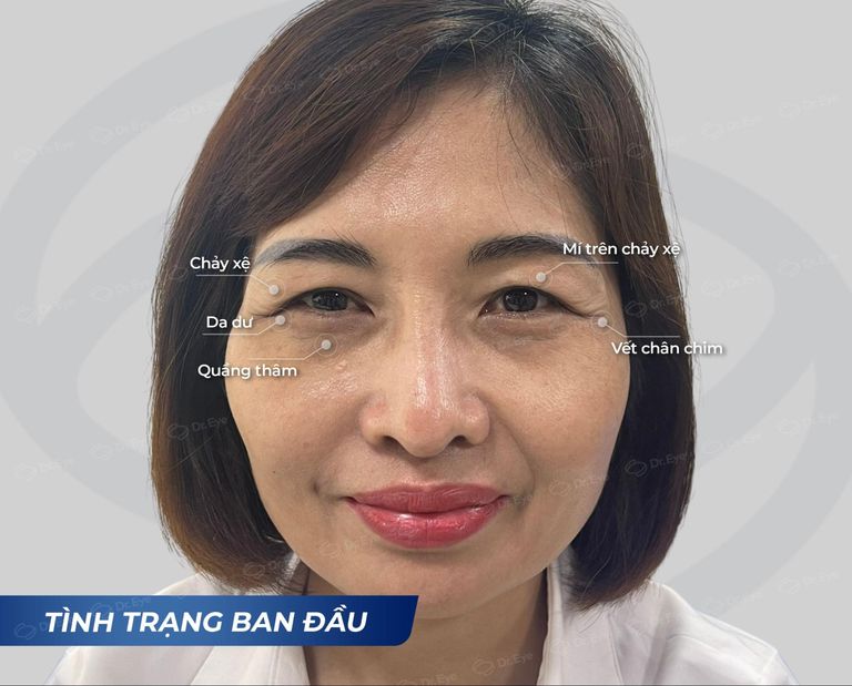 bóc mỡ mắt