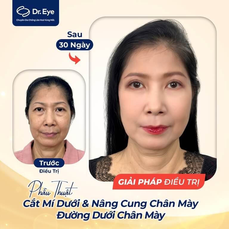 Cắt mí dưới và nâng cung chân mày tại Dr. Eye