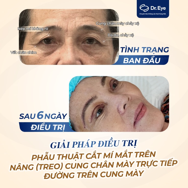 có nên cắt mí khi mới hết kỳ kinh nguyệt không