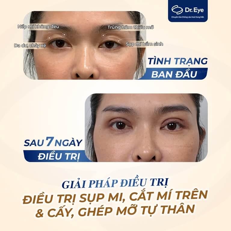 hai mắt không đều là gì