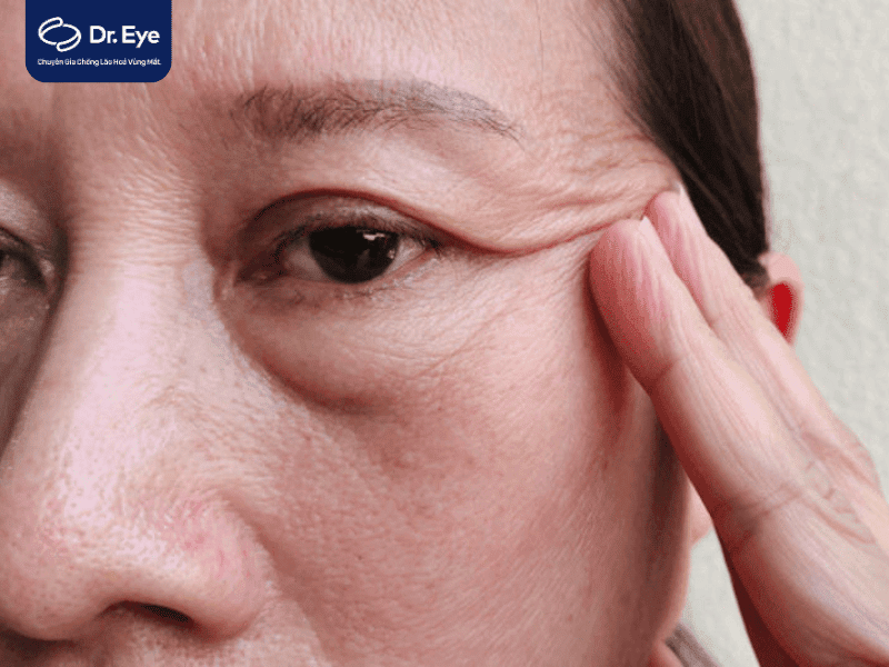 lấy mỡ bọng mắt dưới khoảng bao lâu thì lành