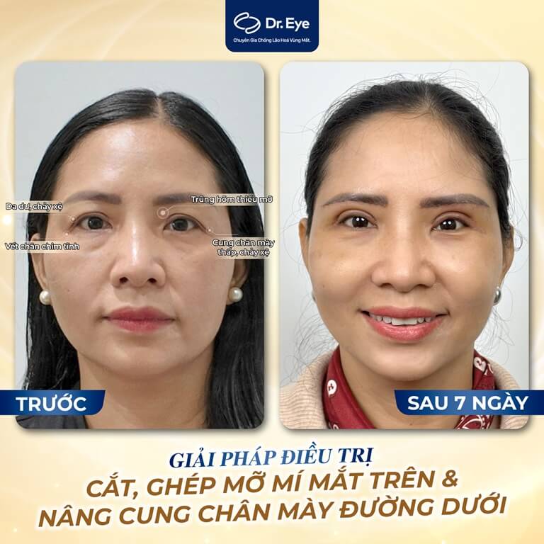 cách làm mắt 2 mí đẹp tự nhiên