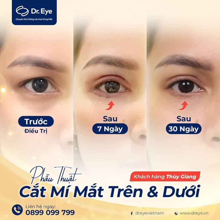 điều trị mắt 3 mí