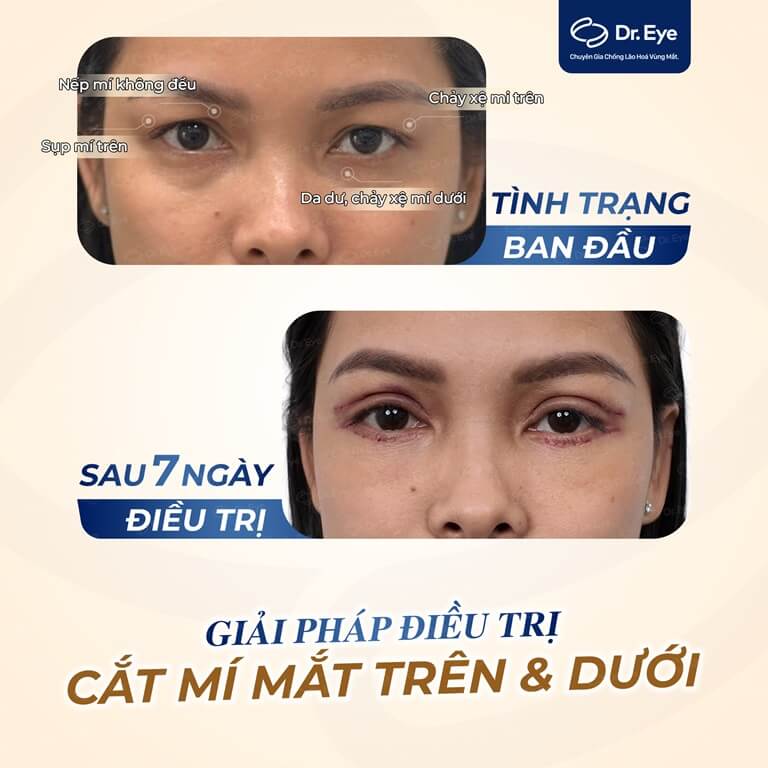 điều trị mắt 4 mí