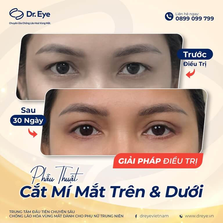 các loại mắt phượng phổ biến