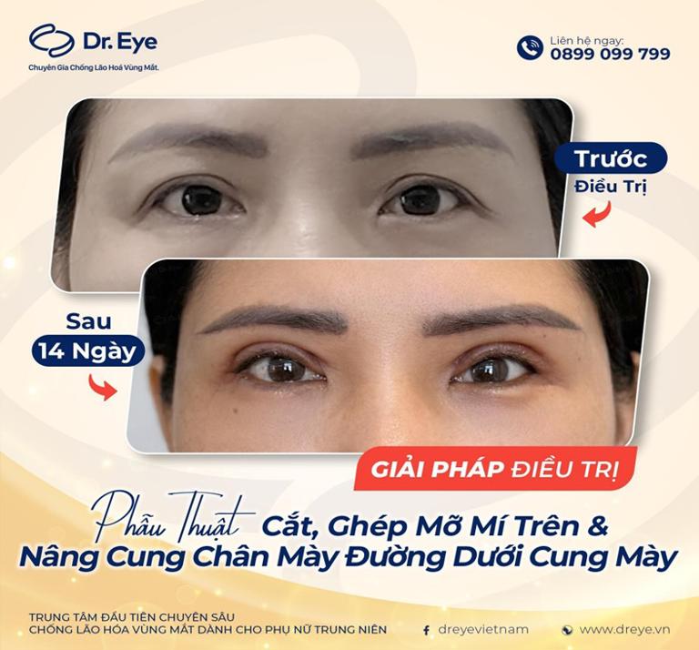 treo cung chân mày giữ được bao lâu