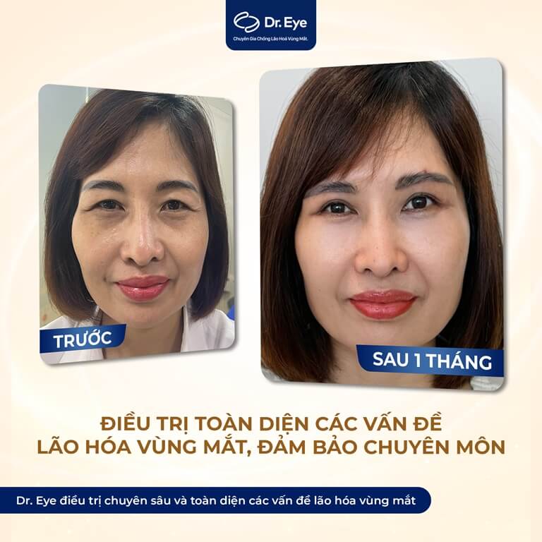 cắt mí mắt ăn hột vịt lộn được không