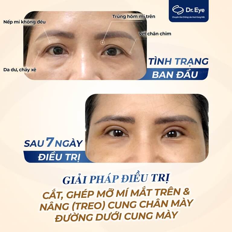 khắc phục tình trạng đuôi mắt cụp xuống