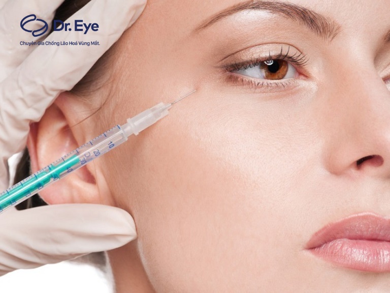 xóa nếp nhăn vùng mắt bằng phương pháp tiêm filler