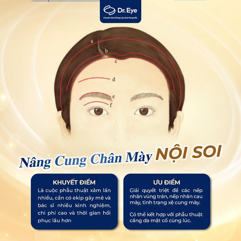 bao nhiêu tuổi thì nâng cung mày nội soi