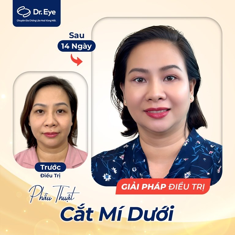 phẫu thuật cắt mí dưới của khách hàng nguyễn thị ngọc anh