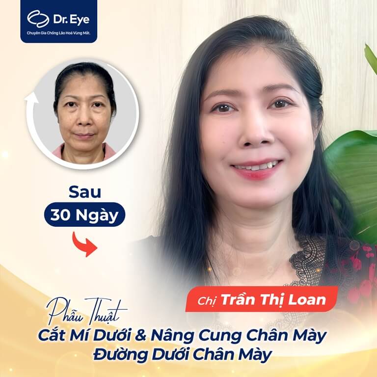 điều trị cắt mí dưới của chị trần thị loan