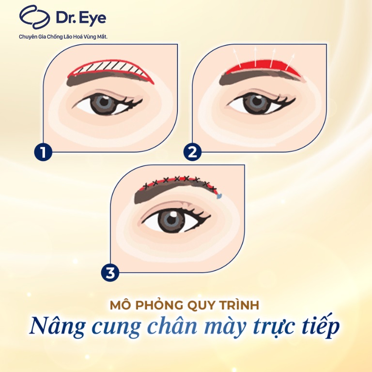 nâng cung mày mấy ngày cắt chỉ