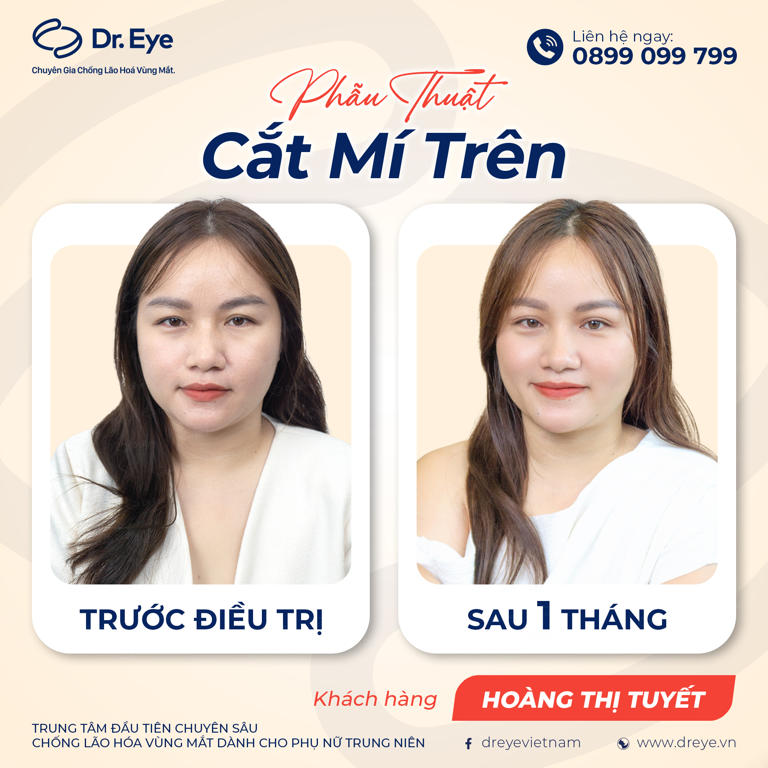 Phẫu thuật cắt mí trên của chị Tuyết