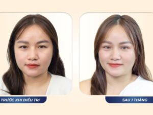 The Eye Rejuvenation Journey of 30-Year-Old TikToker Hoang Thi Tuyet (Mama Hedgehog)
