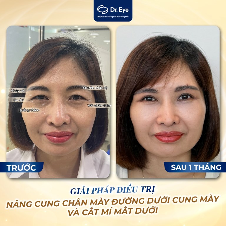 giải pháp thâm mắt bằng bã cà phê