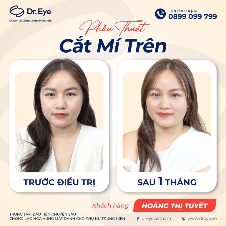 Khách hàng sau khi cắt và lấy mỡ mí mắt trên tại Dr. Eye