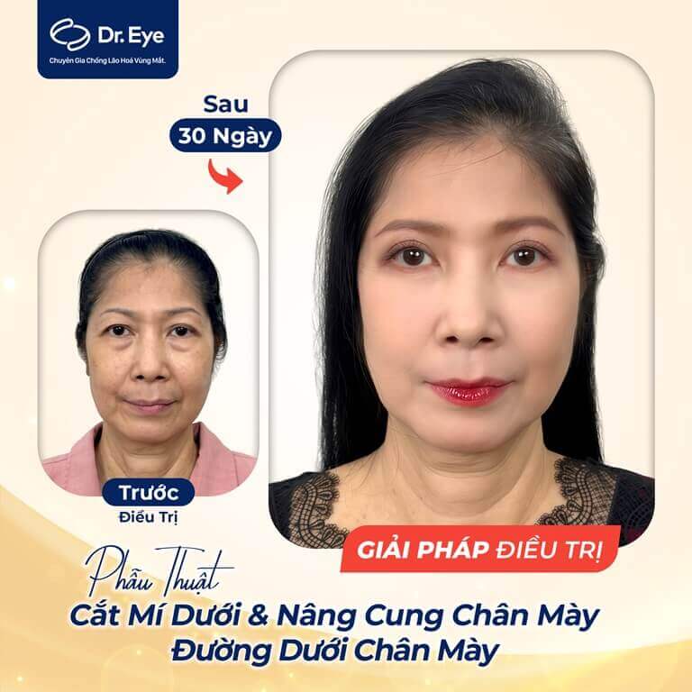 Giải pháp điều trị nâng cung chân mày tại Dr Eye