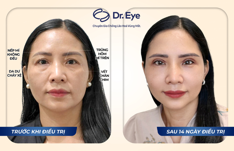 hình ảnh khách hàng điều trị tại Dr Eye