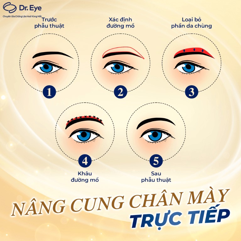 nâng cung chân mày trực tiếp