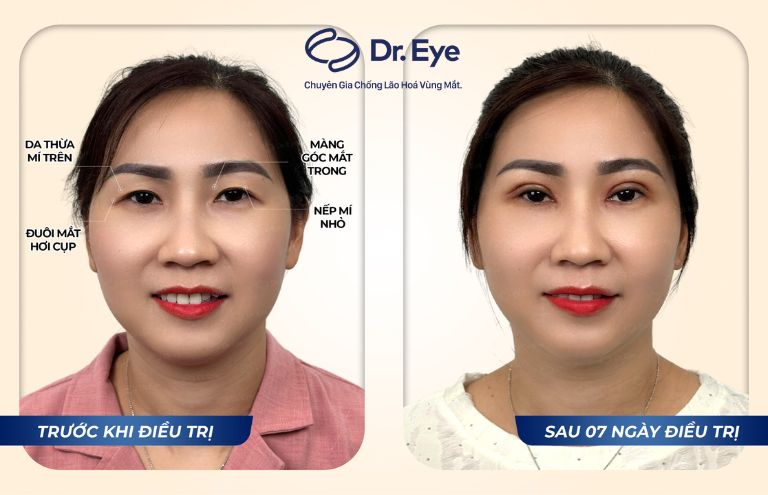 sau khi cắt mí tại Dr. Eye