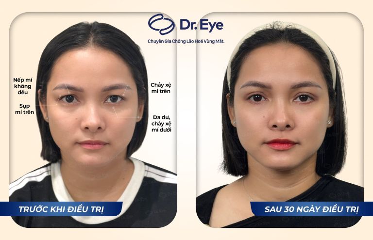 Sau khi phẫu thuật cắt mí trên và mí dưới cùng Dr. Eye