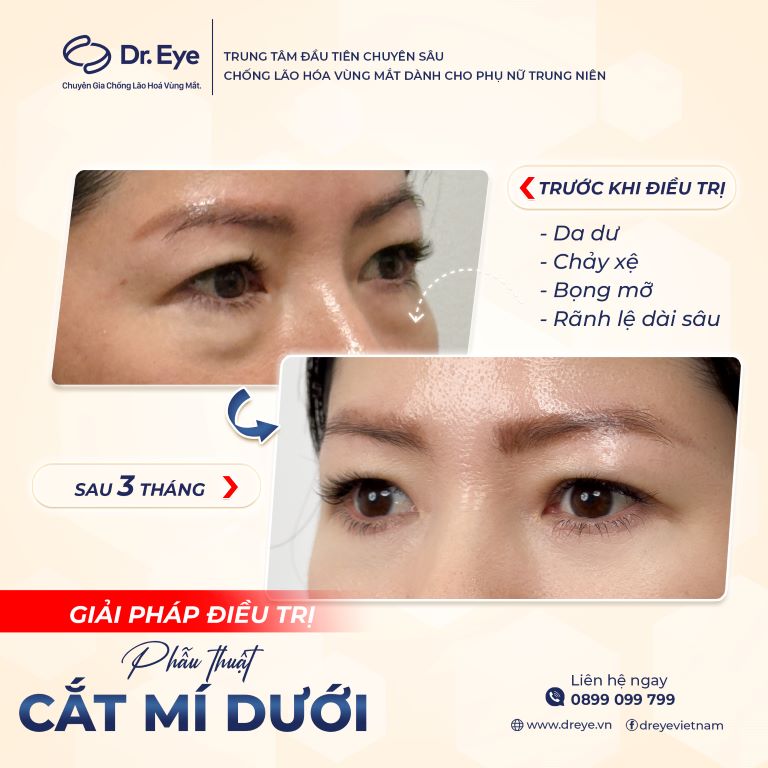 kiêng gội đầu bao lâu sau khi cắt mí 