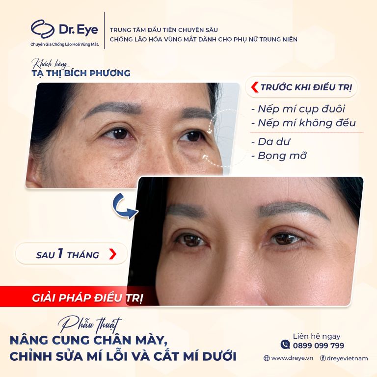 Phẫu thuật nâng cung chân mày tại Dr eye