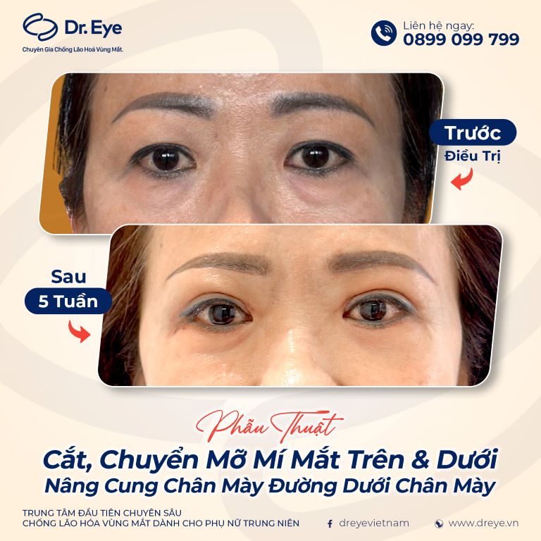 cắt mí có được ăn thơm không