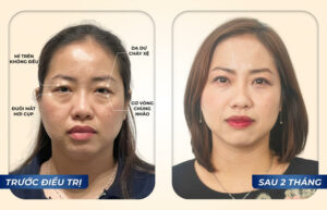 Beautiful natural eyelid surgery thanks to the lucky encounter with Dr. Eye – A good facility with heart and vision