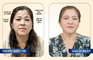 Find back the round, full eyes of youth at the age of U60