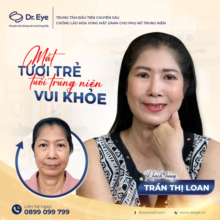 có nên cắt da thừa mí mắt không