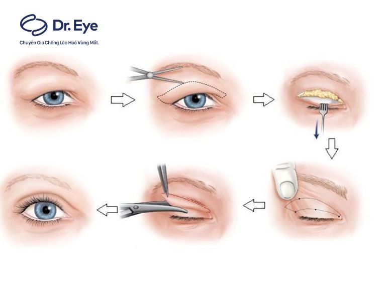 quy trình cắt mí cho trường hợp mí sụp