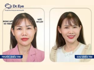 How should single eyelids or hidden eyelids combined with fat bags be treated?