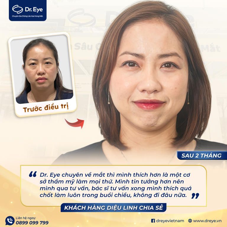 Chị linh thực hiện cắt mí mắt tại Dr eye