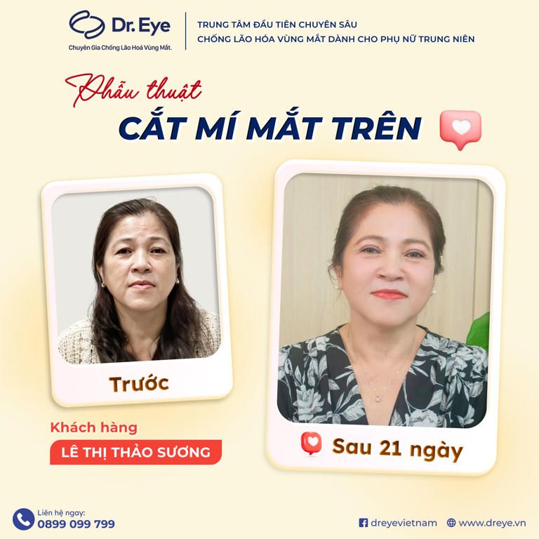 Chị Thảo Sương phẫu thuật cắt mí mắt trên