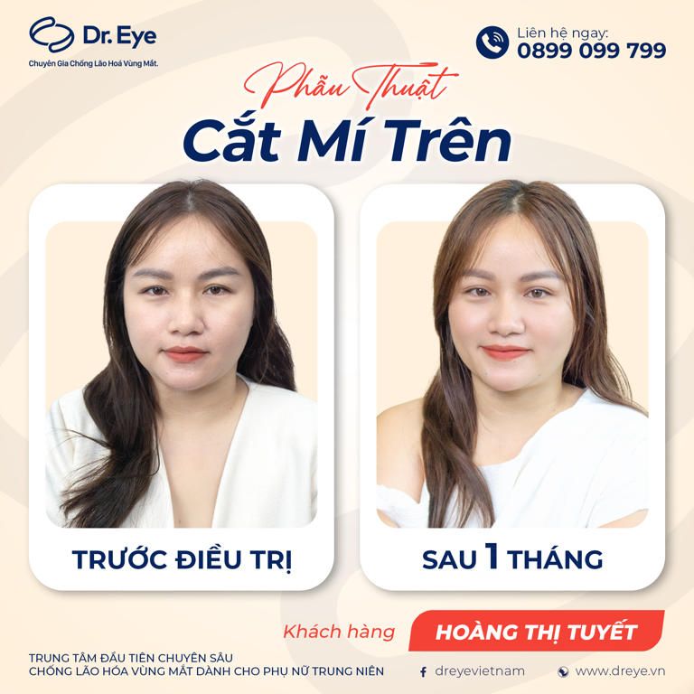 Chị Hoàng Thị Tuyết đã thực hiện cắt mí mắt trên tại Dr eye