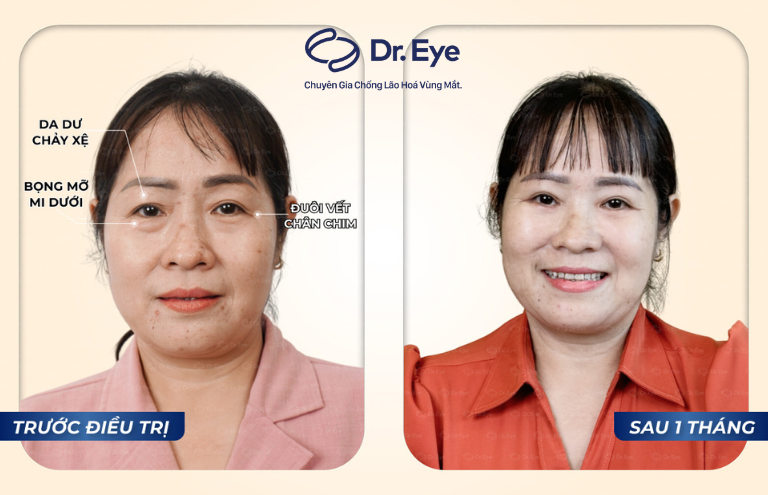 1 tháng điều trị tại Dr. Eye, đôi mắt của chị Quý đã có những thay đổi bất ngờ, với hai mí đều đẹp tự nhiên, tươi tắn hơn, đặc biệt không có tình trạng sưng đau hay bầm tím. 